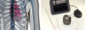 S-ICD Case Report: From Start to Finish