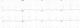 Channelopathy and Cardiomyopathy